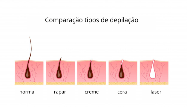 comparação tipos de depilação