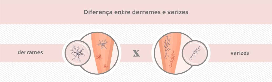 Depilação-derrames-varizes_Porto